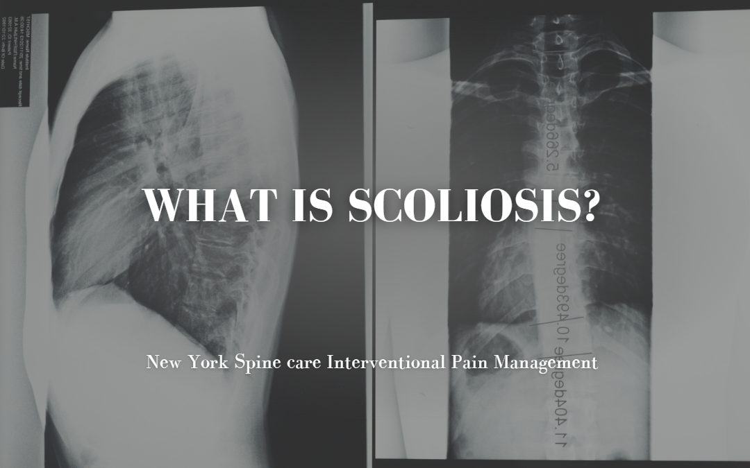 What Is Scoliosis? | NY Spine Care Interventional Pain Management ...